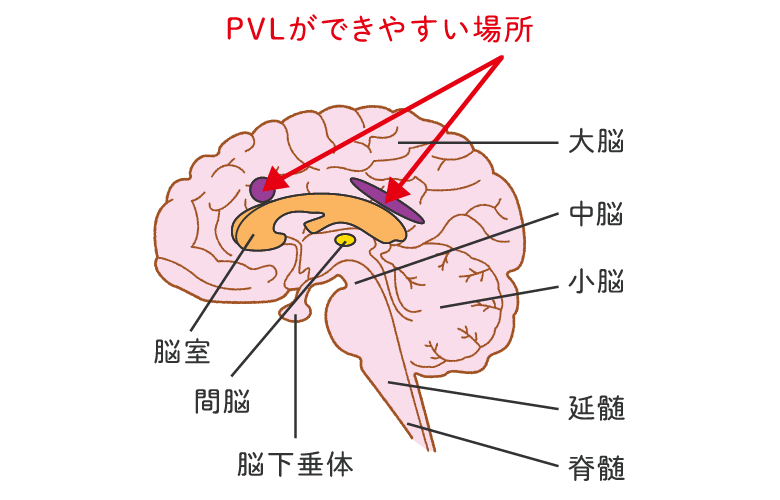 小さく生まれた赤ちゃんについて はじめてのnicu